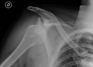 Fig.3 – esame radiografico di lussazione gleno-omerale anteroinferiore